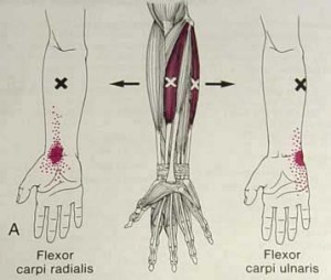 carpi ulnaris tendon